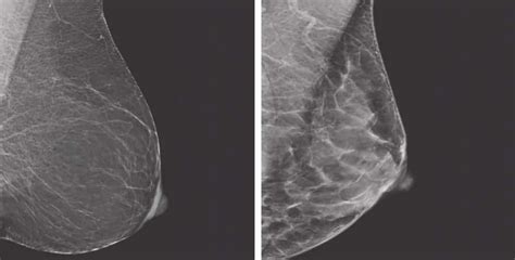 Breast Density And What It Means For You According To The New Medical