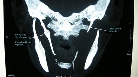 drtbalu's otolaryngology resources: Eagle's syndrome