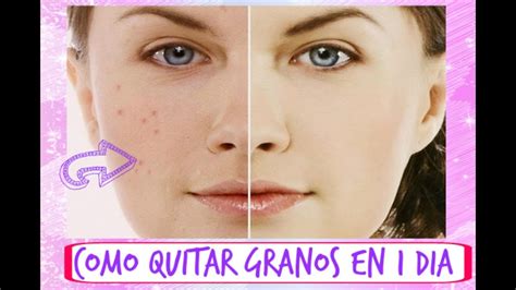 Como quitar granos del rostro en 1 día Rápido y eficaz Tipsbyaime