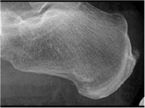 Musculoskeletal Joints and Tendons | 6.7 Ankle : Case 6.7.6 Achilles tendon bursitis ...