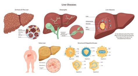 Premium Vector Liver Diseases Set Hepatic System Organ Pathology