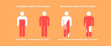 Spinal Cord Injury Types