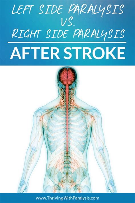 Paralysis After Stroke: Left Side vs. Right Side Paralysis