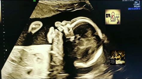 Patau Syndrome Triosomy 13 Ultrasound By Drhaissam Aref Dms Msc Md