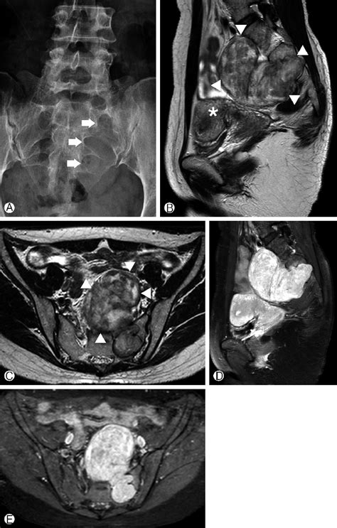 Figure From Single Stage Posterior Approach For Total Resection Of