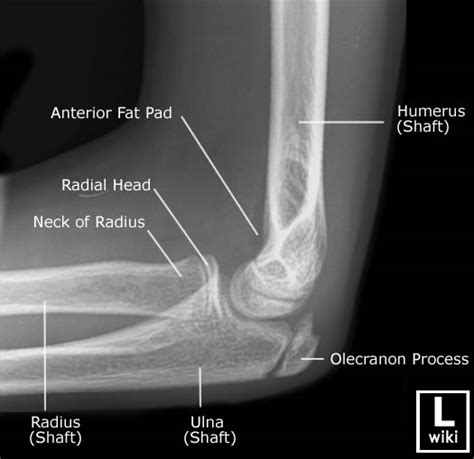 Pediatric Elbow Anatomy – RADIOLOGYPICS.COM