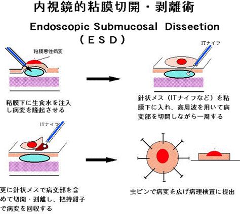 早期胃癌の内視鏡的治療