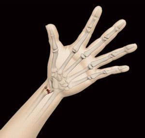 Hand Fractures NSW | Hand Injury Treatment NSW