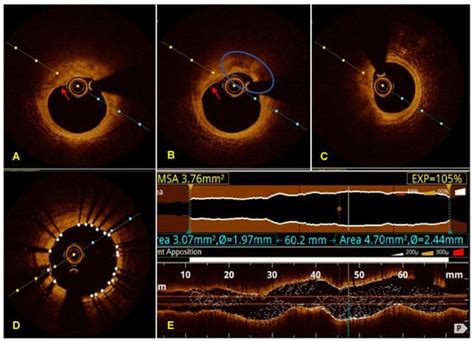 Diagnostics Free Full Text Acute Coronary Syndrome With Non