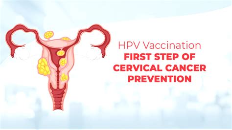 Guarding Against Cervical Cancer The Role Of Hpv Vaccination And Early