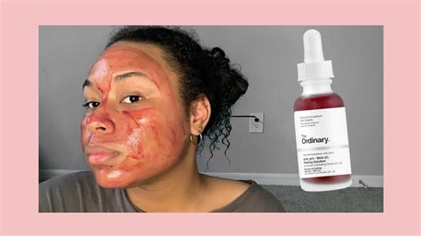 I Tried The Ordinary Peeling Solution For 3 Weeks Youtube