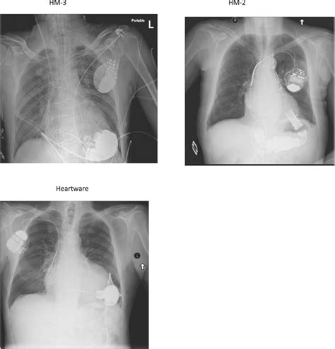 Acls Algorithm For The Left Ventricular Assist Device Lvad Supported