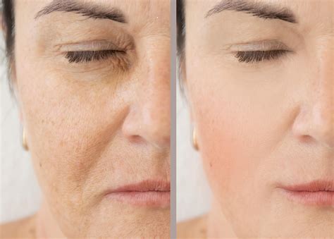 Tratamiento De Fotoenvejecimiento Facial En Granada Ghorchi Clinic