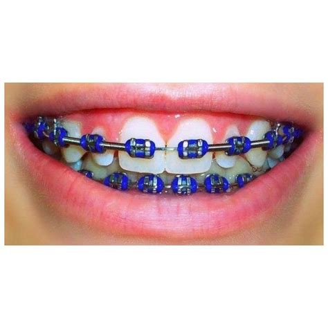 20 best Braces Colors images on Pinterest