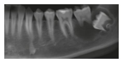 Preoperative Radiographic Examination Cbct Panoramic Reconstruction