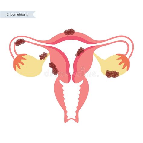 Uterus Stock Illustrationen Vektoren Kliparts 946 Stock