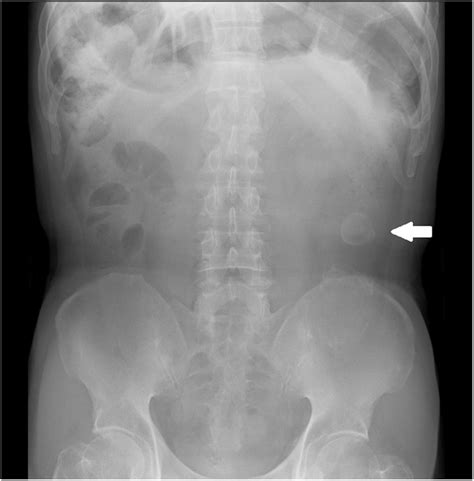 Upper Abdominal Distention