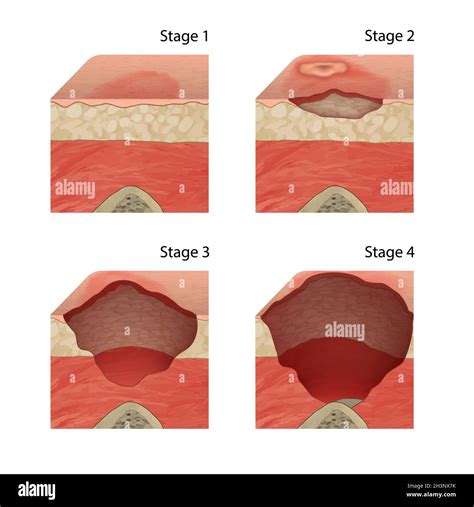 Bed Sores Stage 2 Illustration Cut Out Stock Images Pictures Alamy