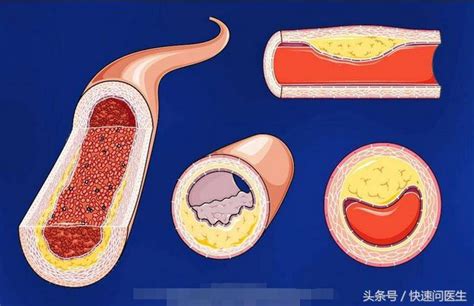 多發性腦動脈硬化的症狀有哪些 很多症狀都是需要了解的 每日頭條