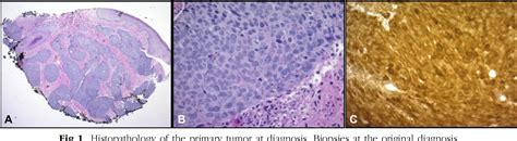 Figure 1 From A Rare Case Of Anal Squamous Cell Carcinoma Metastasizing To The Scrotum