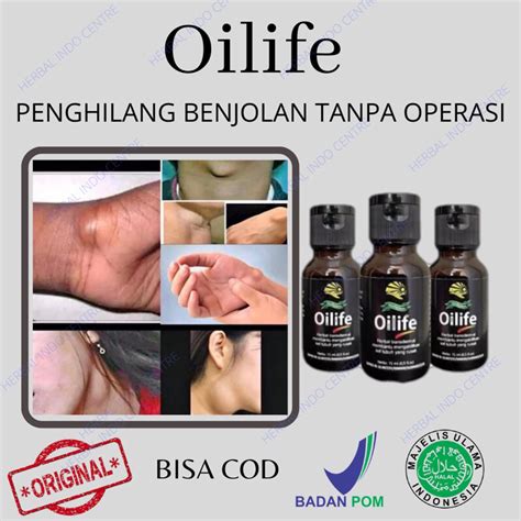 Jual Obat Benjolan Obat Lipoma Obat Oles Benjolan Bengkak Di Tubuh