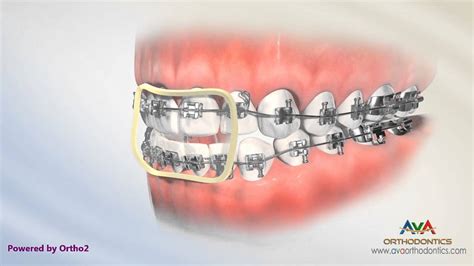 Correcting Openbite By Rubber Bands Orthodontic Instruction Youtube