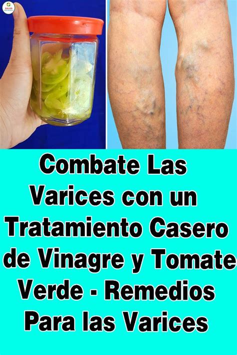 Pin En Remedio Para Las Varices