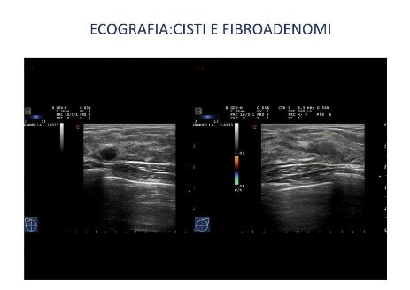 TUMORE AL SENO Matteoincarbone It