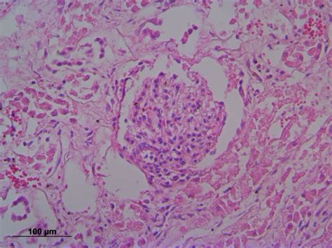 Glomerular Histopathology Showing Glomerulonephritis Download