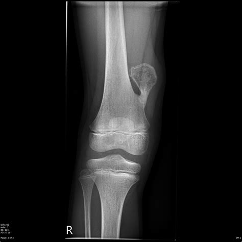 Osteochondroma Distal Femur Image Radiopaedia Org