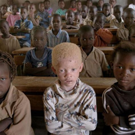 Albino People Hunted In Africa