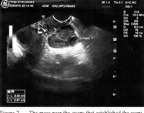 Figure 2 From Heterotopic Triplet Pregnancy After In Vitro