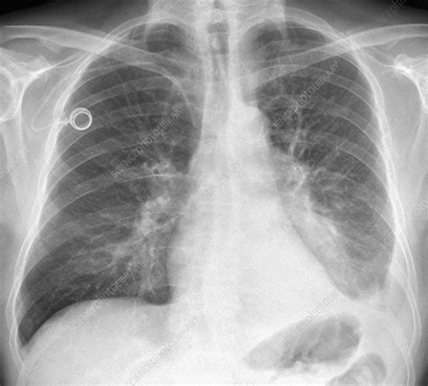 Chest X Ray Lung Cancer