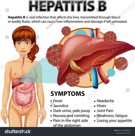 Symptoms Hepatitis B Illustration Stock Vector (Royalty Free