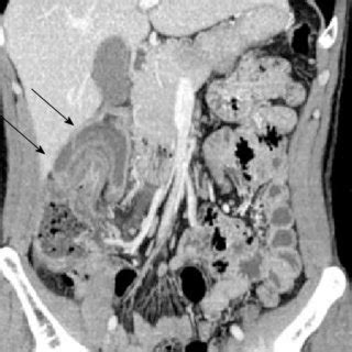 Abdominal Contrast Enhanced Computed Tomography CT Imaging The