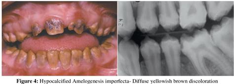 Amelogenesis Imperfecta