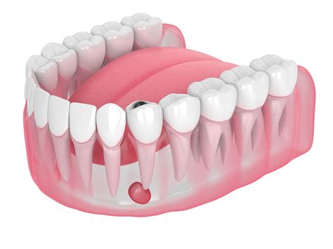 What causes a dental abscess?