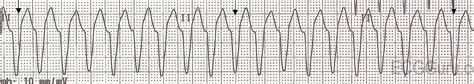 ECG Basics: Ventricular Tachycardia | ECG Guru - Instructor Resources