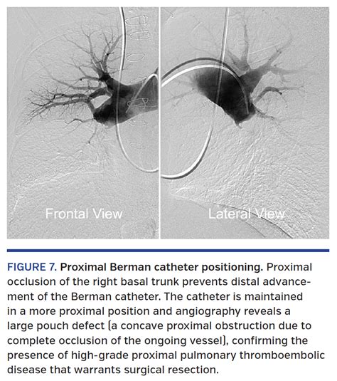 Optimal Technique for Performing Invasive Pulmonary Angiography for ...