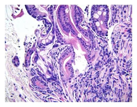 Duodenal Mucosa A And B Moderate To Severe Shortening Of Most