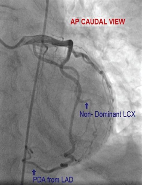 Circumflex Artery