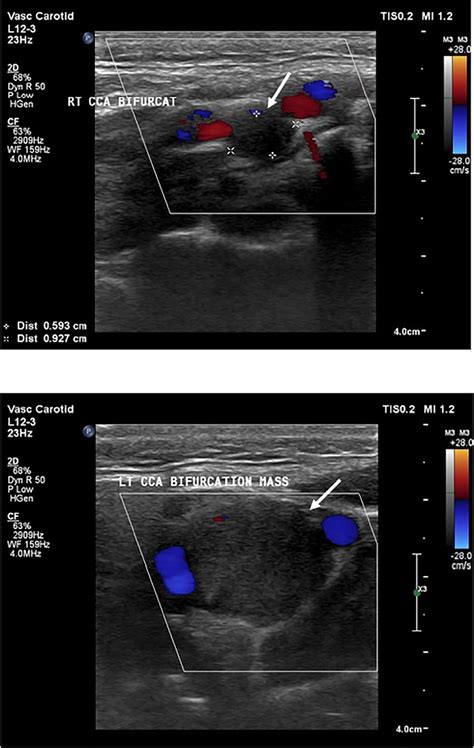 A And B Ultrasound Shows Solid Well Defined Hypoechoic Mass Located