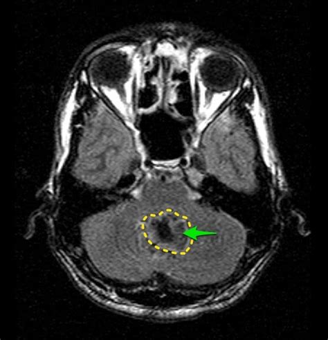 Epidermoid Cyst Brain Mri