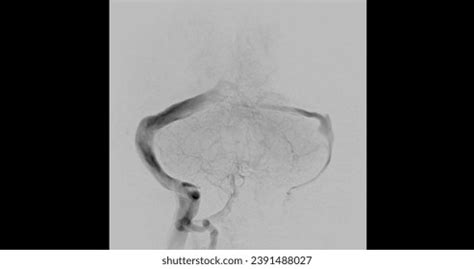 Cerebral Angiogram Medical Imaging Procedure Used Stock Photo ...