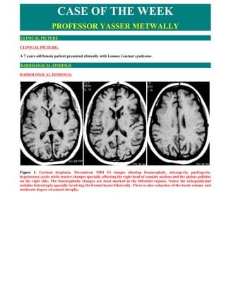 Case record...Cortical dysplasia | PDF