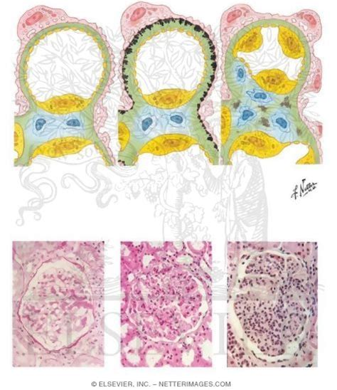 Pathology of the Nephrotic Syndrome