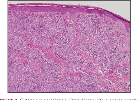 Figure 1 From Perianal Condyloma Acuminatum Like Plaque Semantic Scholar