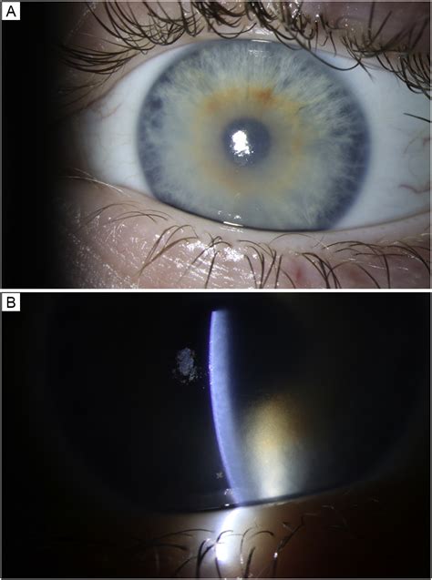 Amantadine Induced Bilateral Corneal Edema In A Pediatric Patient