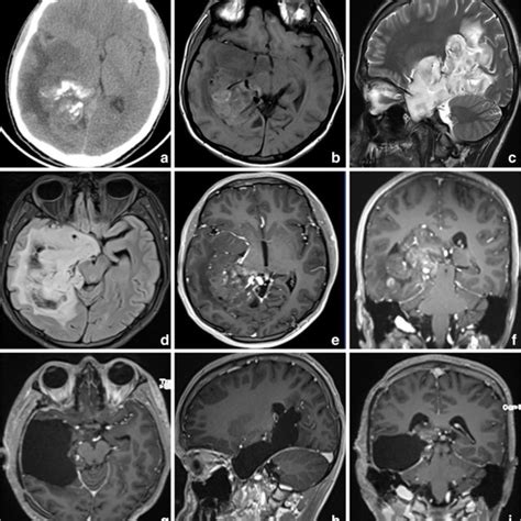 Ct Brain Plain Image A Shows A Large Hypodense Lesion Involving Right Download Scientific