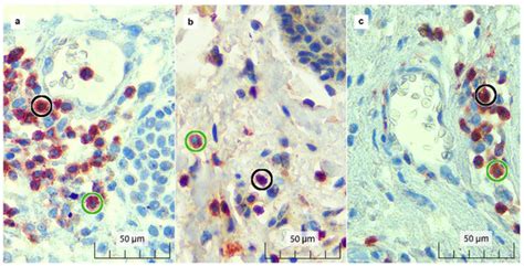 Diagnostics Special Issue Skin And Cutaneous Adnexal Tumors